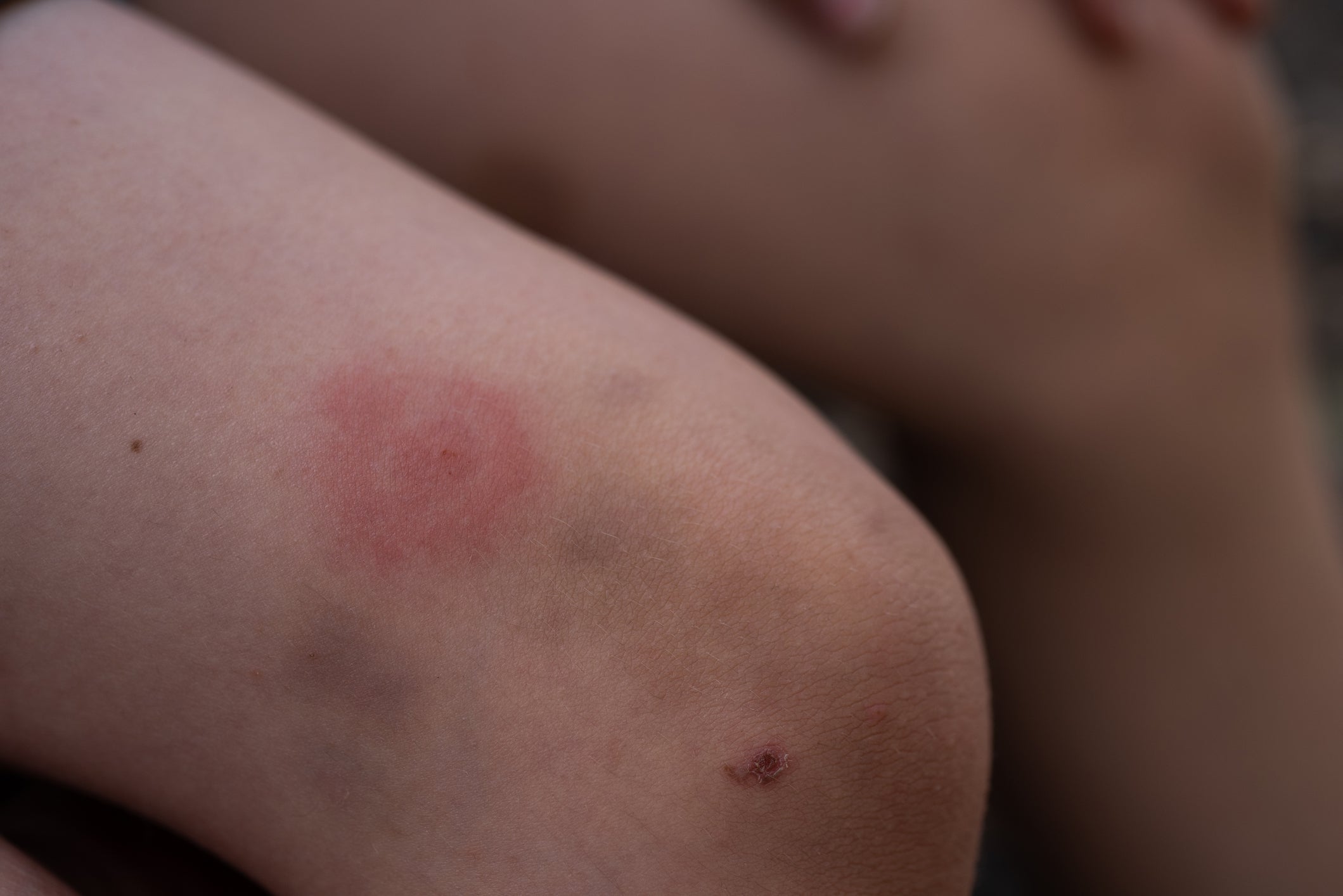 It's Tick Season – If They End Up On You Or Your Kids, This Is How To Remove Them