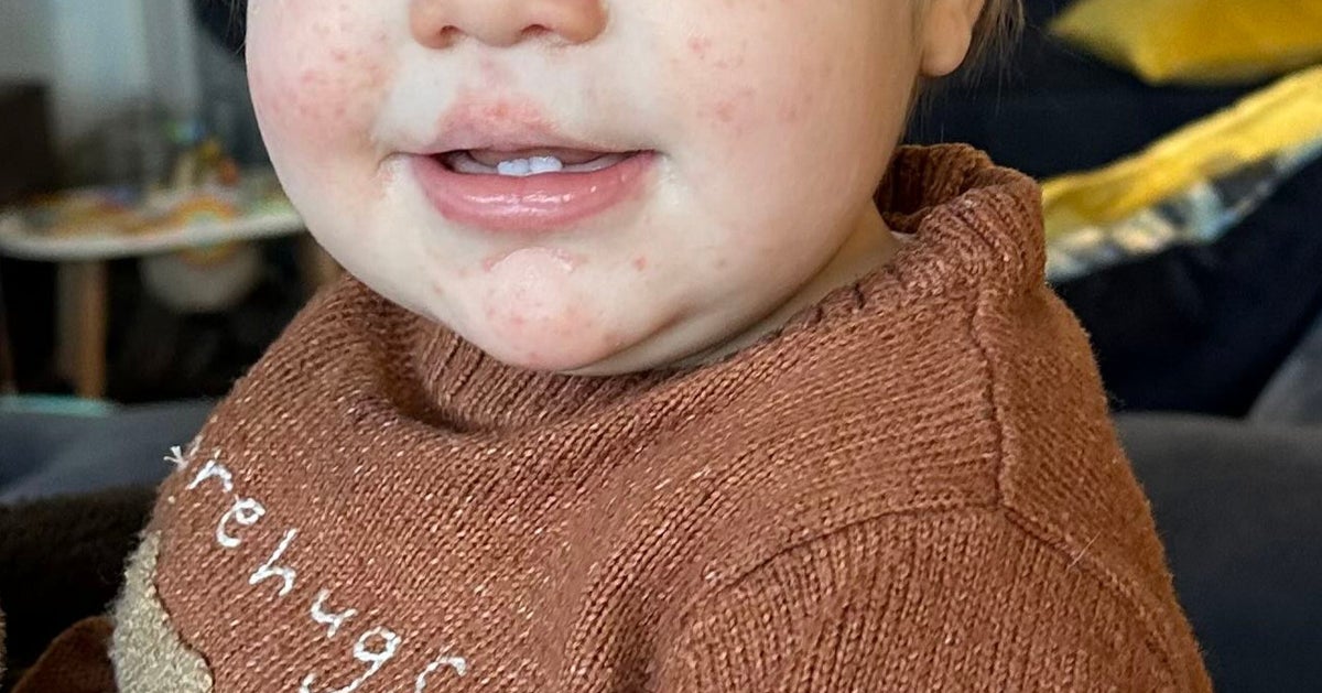 Chickenpox, Impetigo Or Hand, Foot And Mouth? Here's How To Spot The Difference