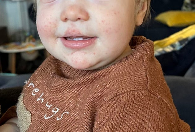 A child with chickenpox