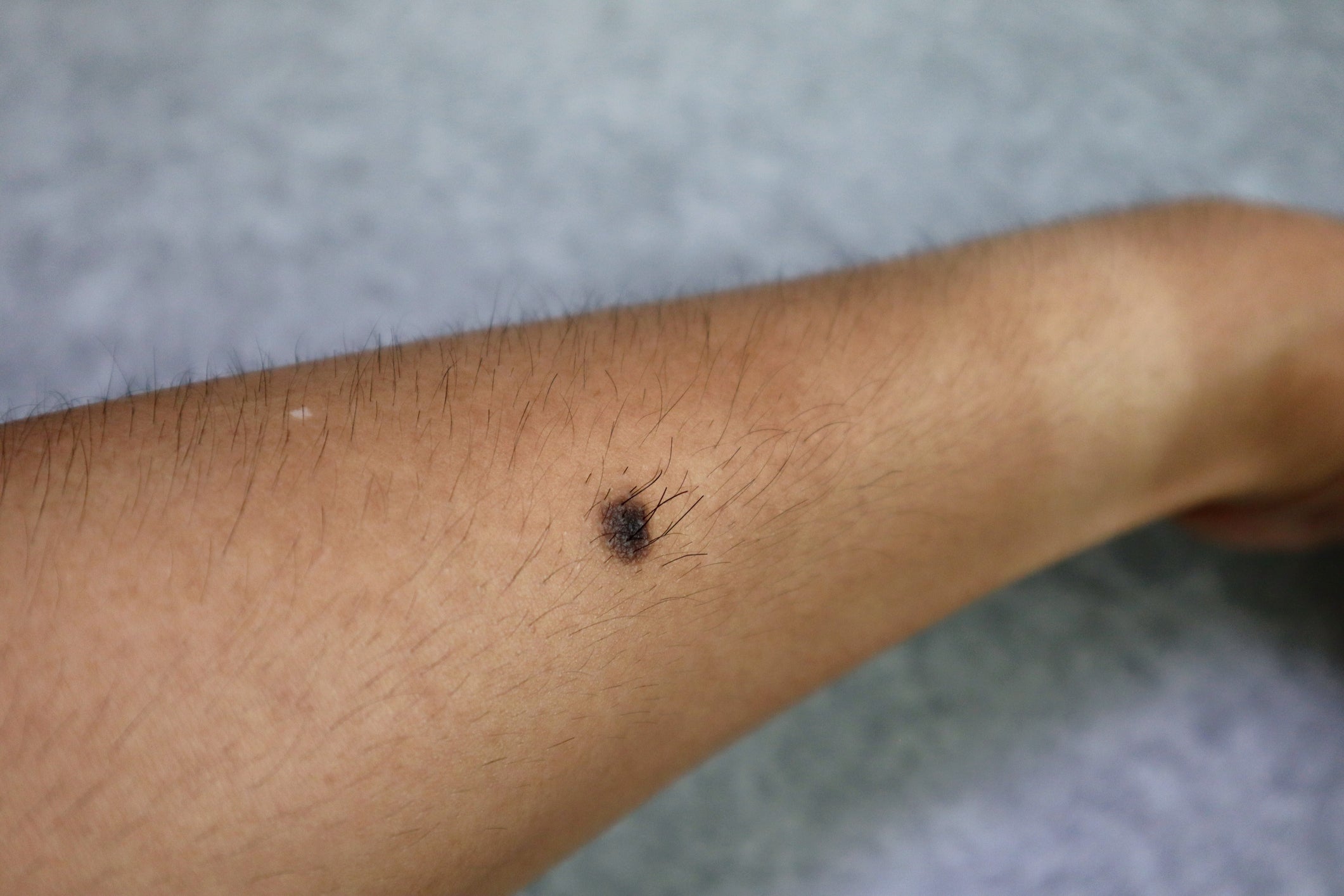 Why Are Mole Hairs Are So Thick And Dark, And What Does A Hairy Mole Mean?