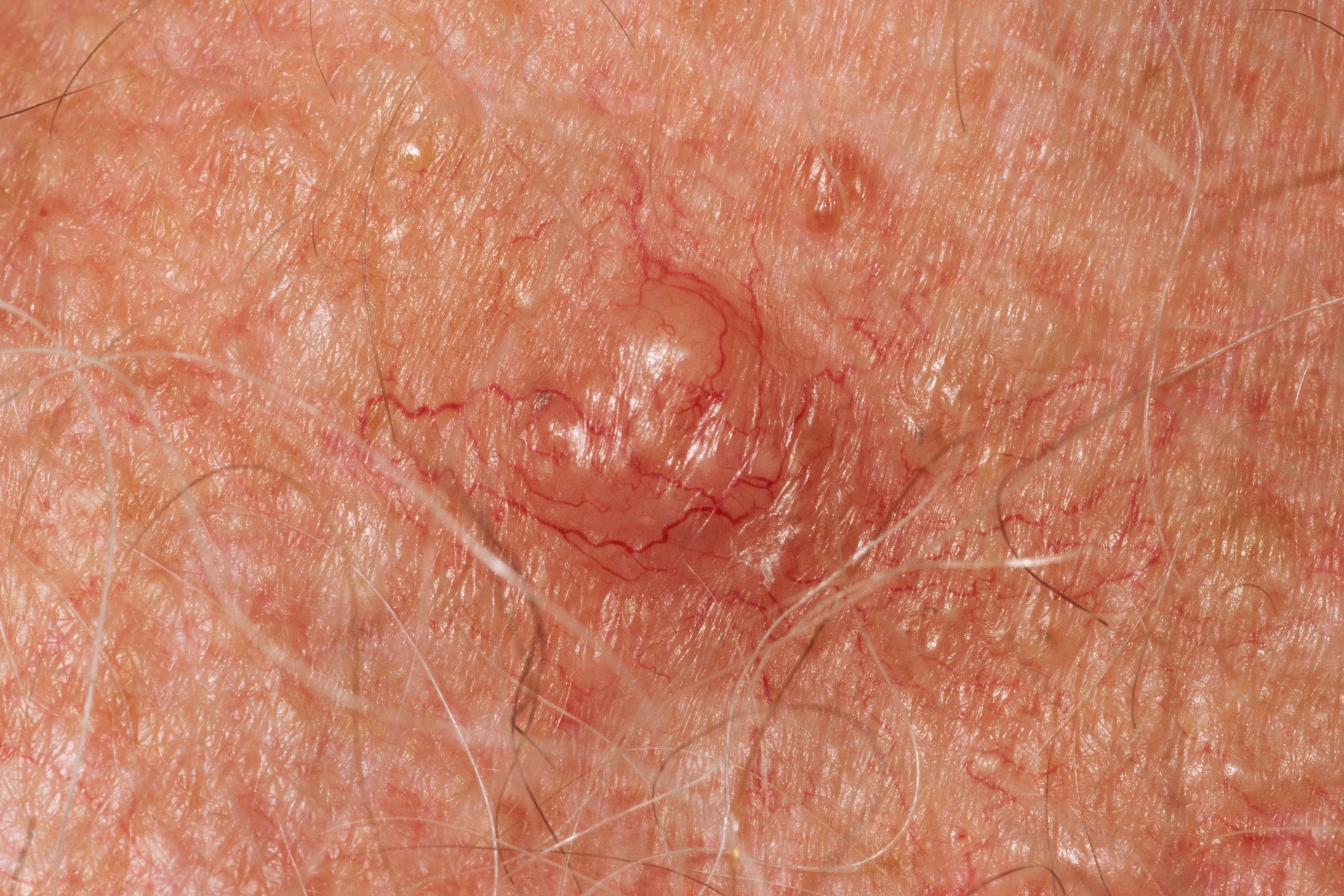 It's Not Just Your Moles: The Skin Changes That Could Flag Cancer