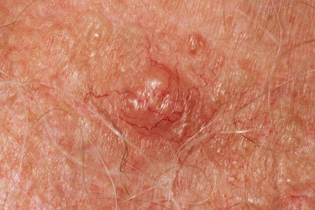 Skin cancer, close-up.