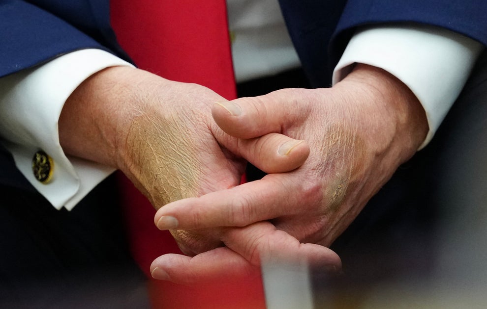 Both Trump’s Hands Badly Bruised, Oval Office Photo Shows