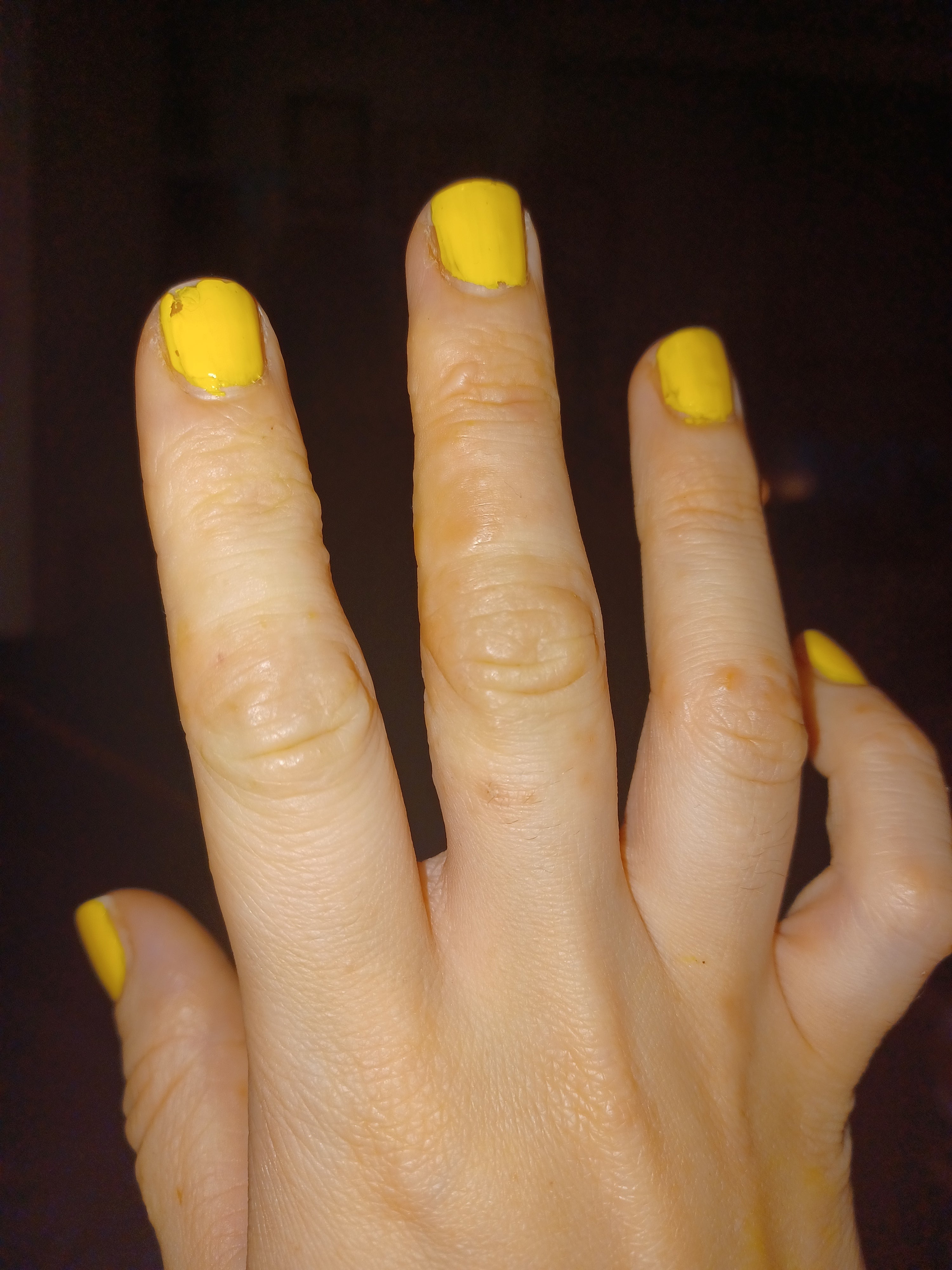 So THAT's Why Your Fingers Suddenly Have Tiny Itchy Bumps
