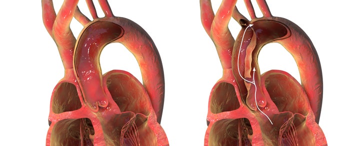 Illustration of a normal aorta, left, compared with aortic dissection, right. This is a critical cardiovascular emergency where a tear in the innermost layer of the aortic wall allows blood to flow between the wall layers. It requires rapid diagnosis and treatment.