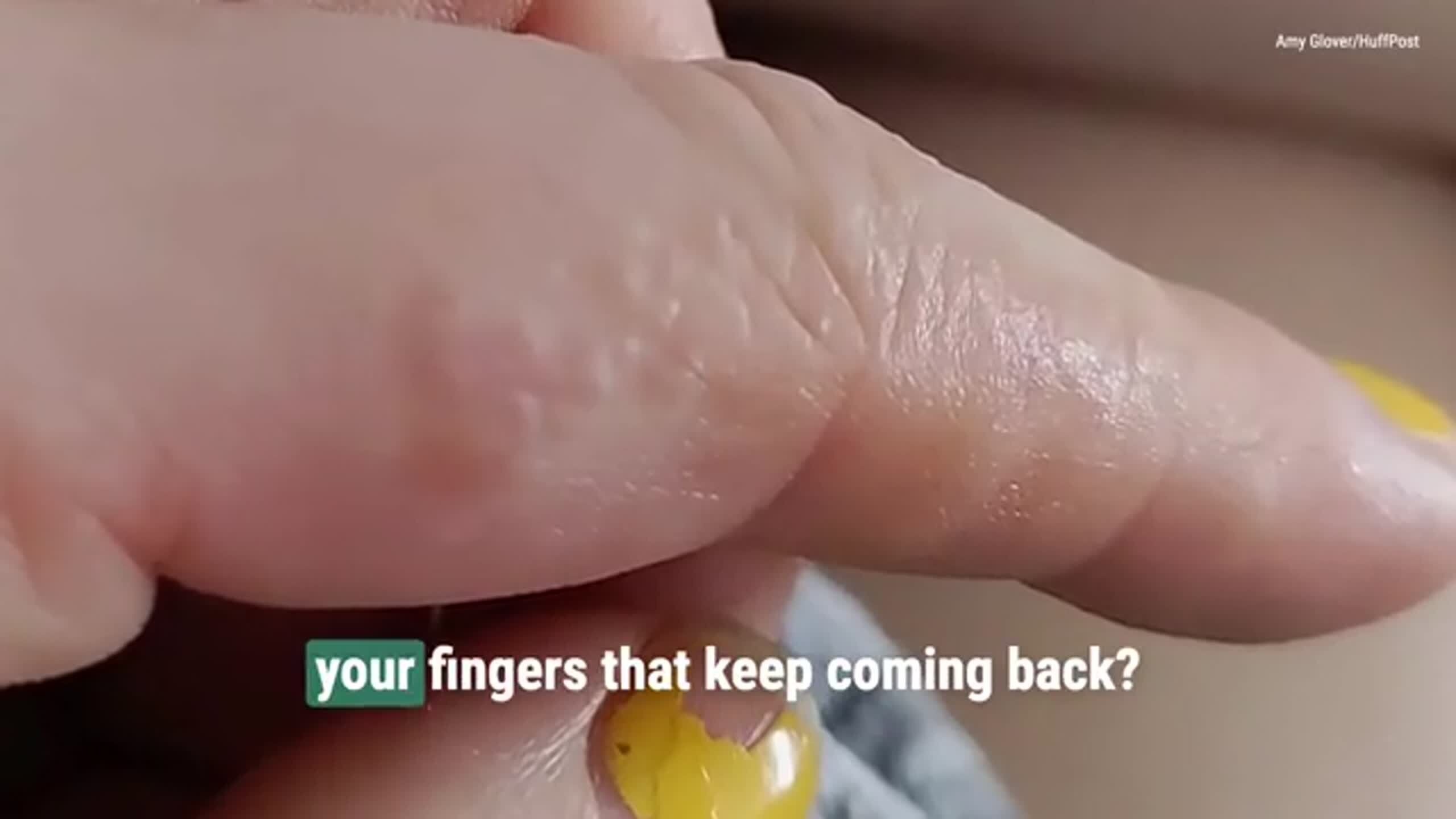 Do you ever get tiny itchy bumps on your fingers?