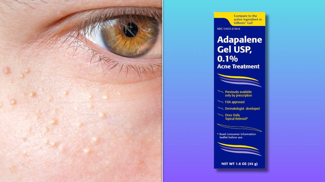 Those ‘Hard White Bumps’ On Your Face Have A Name — And There’s An $11 Fix
