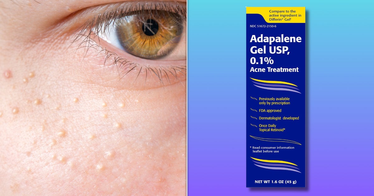 Those ‘Hard White Bumps’ On Your Face Have A Name — And There’s An $11 Fix