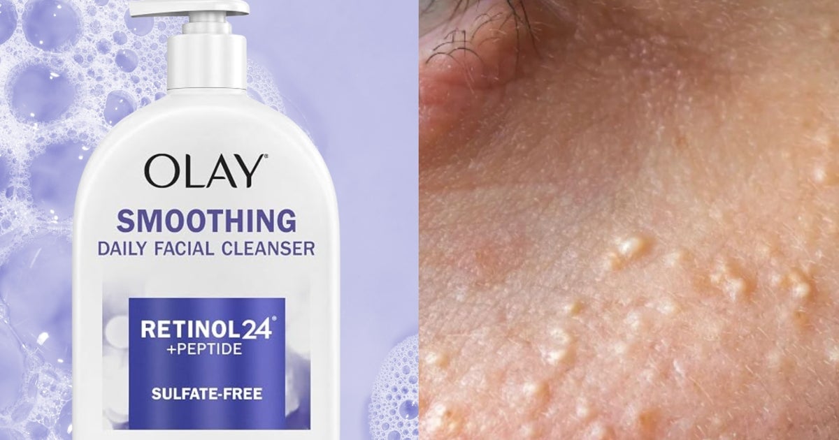 Those Pesky White Bumps Under Your Eye May Have A $10 Fix, According To A Derm
