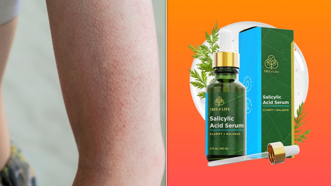 Menschen mit Keratosis Pilaris sagen, dieses Serum habe ihnen „weniger ...