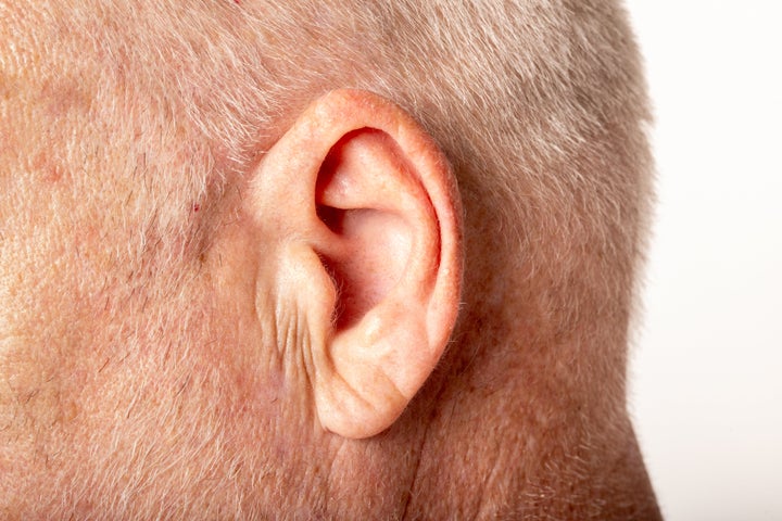 Frank’s sign — a crease in your earlobe that could indicate potential heart problems — extends from the earlobe to the tragus and is often deeper than normal signs of aging. The photo above shows a standard skin wrinkle.