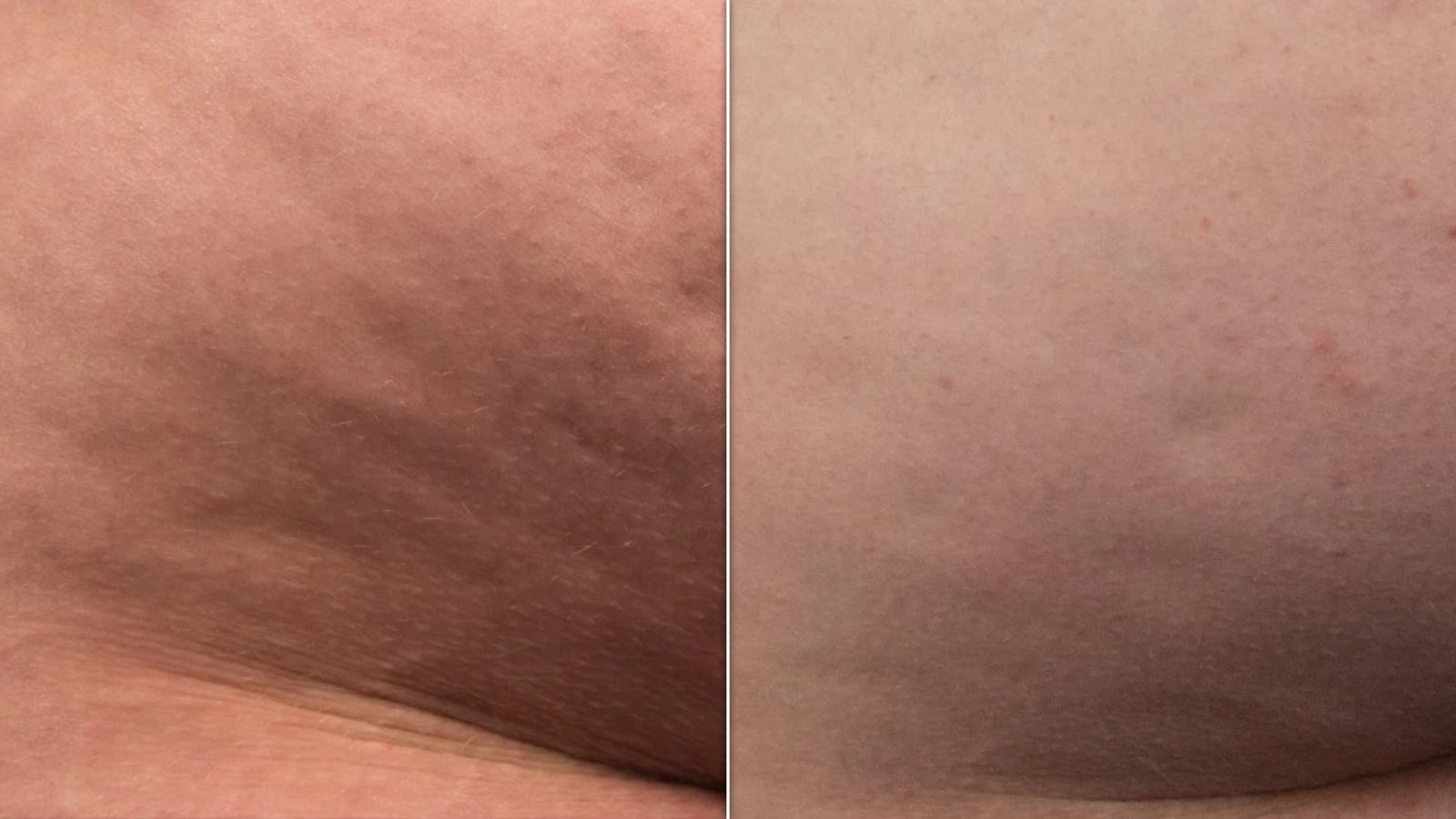 I Tried Augustinus Bader’s New Body Cream – And My Cellulite Has Never Looked Better