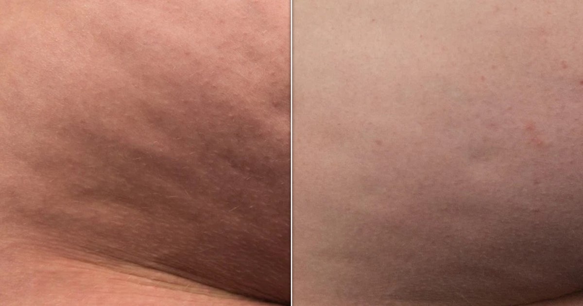 I Tried Augustinus Bader’s New Body Cream – And My Cellulite Has Never Looked Better