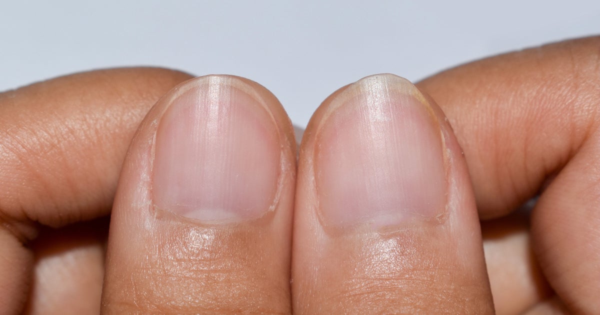 A Tiny Change To Your Fingernails Could Show Hidden Disease