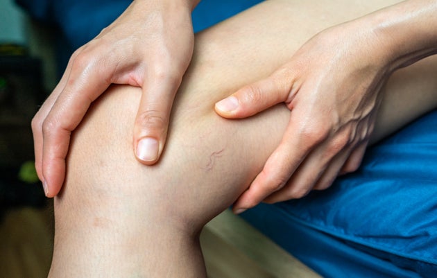 Varicose veins are a common condition caused by weak or damaged vein walls and valves.