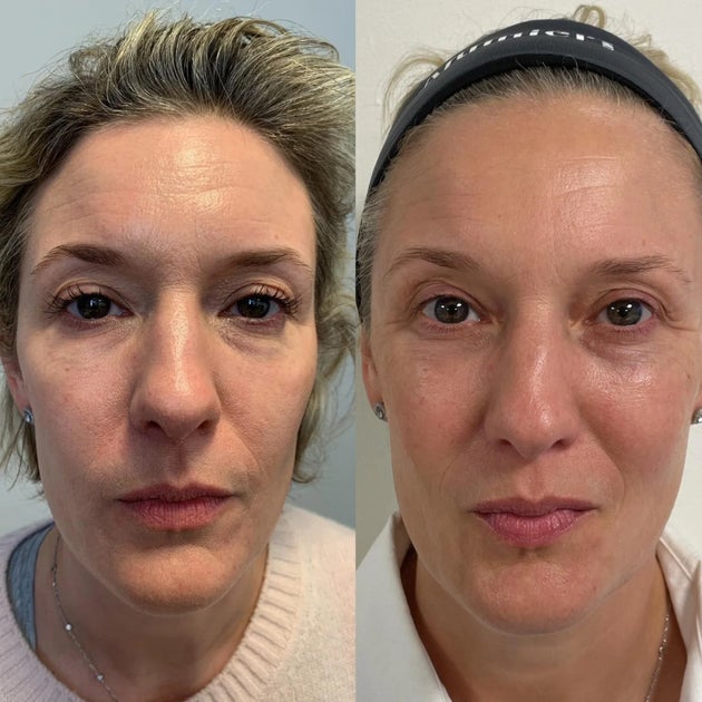Before using Rescue Balm versus after.