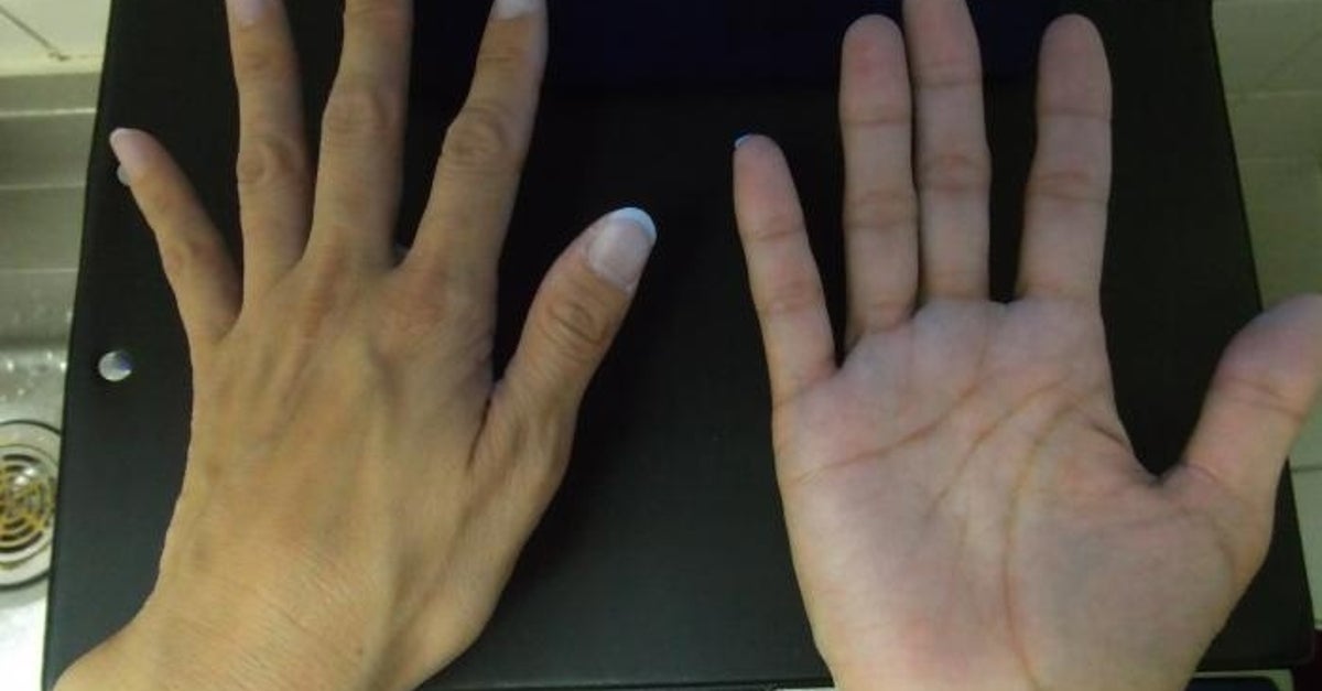 洗った手にブラックライトを当てる⇨こんなに洗い残しが!特に汚れが取れない部分はどこ?