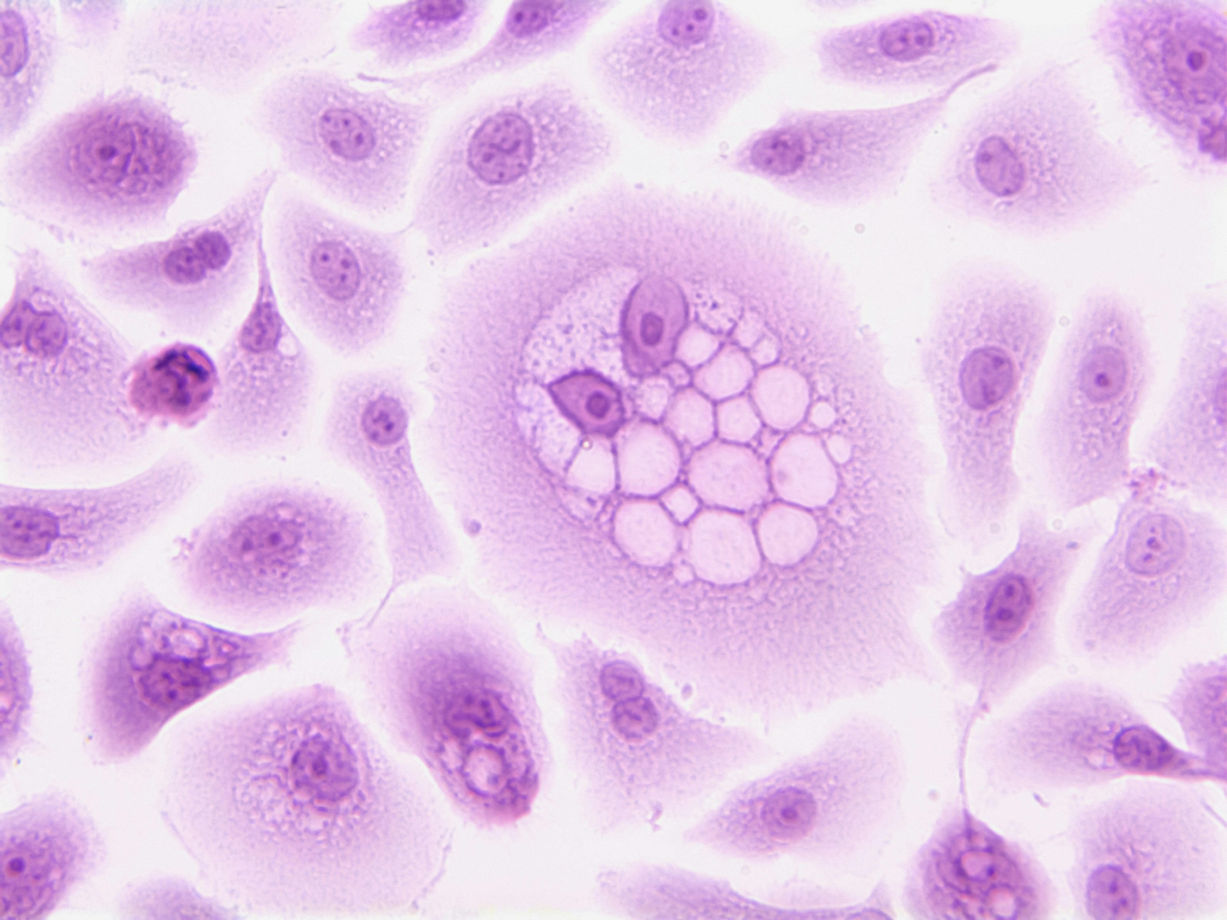 Researchers Think Cancer's Own Byproducts Could Help Kill If Off