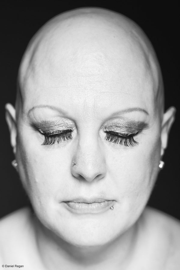 Powerful Photos Of People With Alopecia Prove Bald Is Beautiful | HuffPost